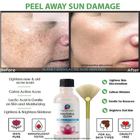 Lactic Acid peel