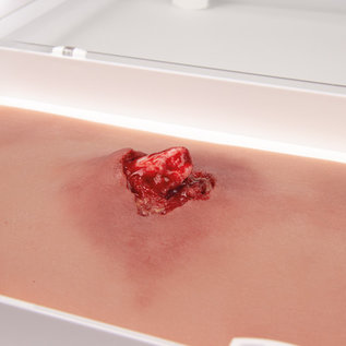 Erler Zimmer Open arm fracture  with bleeding function