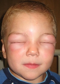 6 Tips for Parents of Children with Allergies