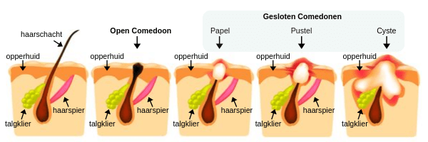 Wat te doen tegen acne