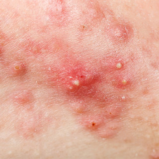 Alles voor de verzorging van een huid met acne