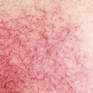 Alles voor de verzorging van een huid met rosacea
