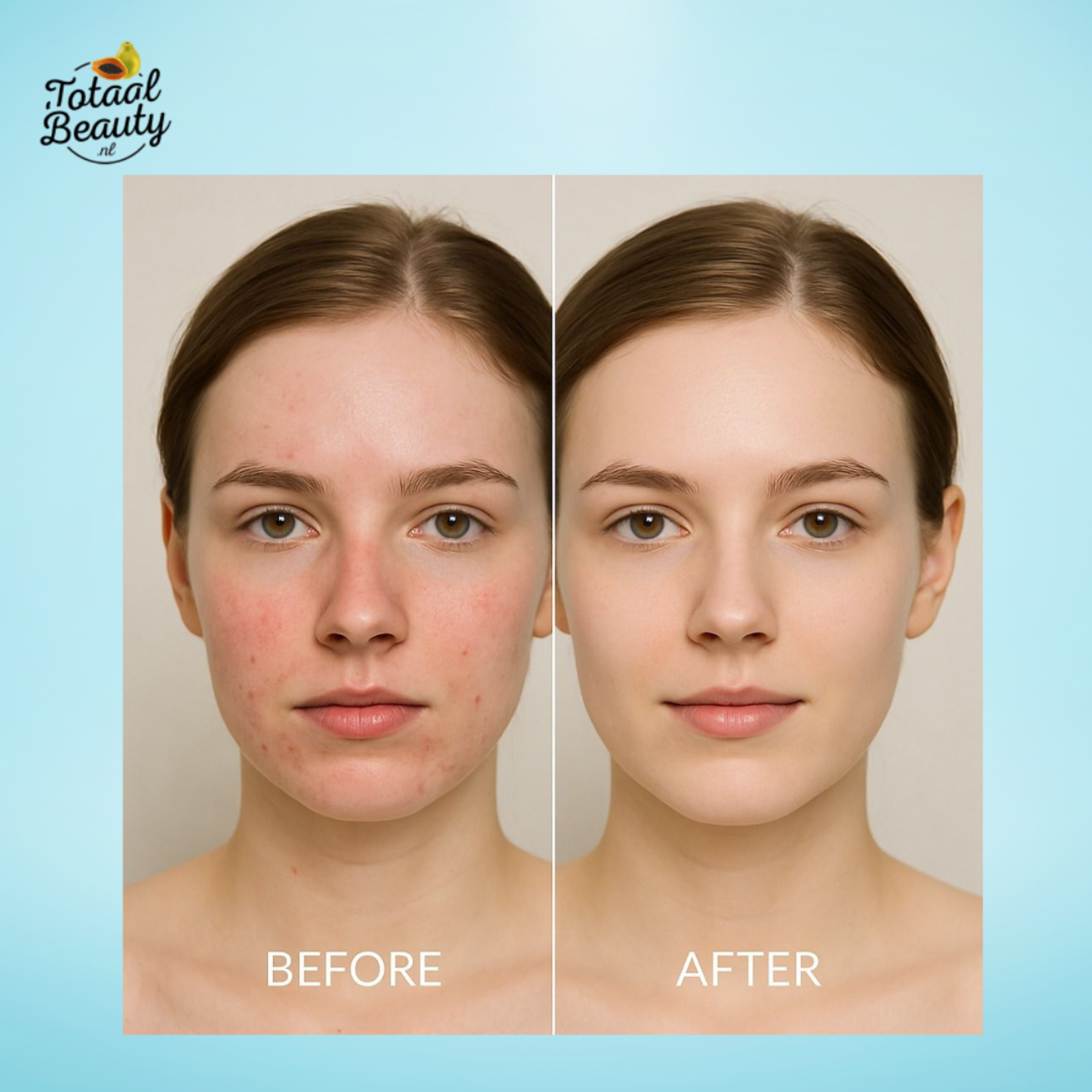 Kojie San, nummer één in anti-pigment producten! Kojie San Skin Lightening Soap – Voordeelbundel 2+1 Gratis – 9 Zepen van 100g – Tegen Pigmentvlekken – Donkere Vlekken Verwijderaar – Egale Huid – Anti Acne – Kojic Acid Zeep – Pigmentvlekken Verwijdering – Gezichts- & Lichaamsreiniging