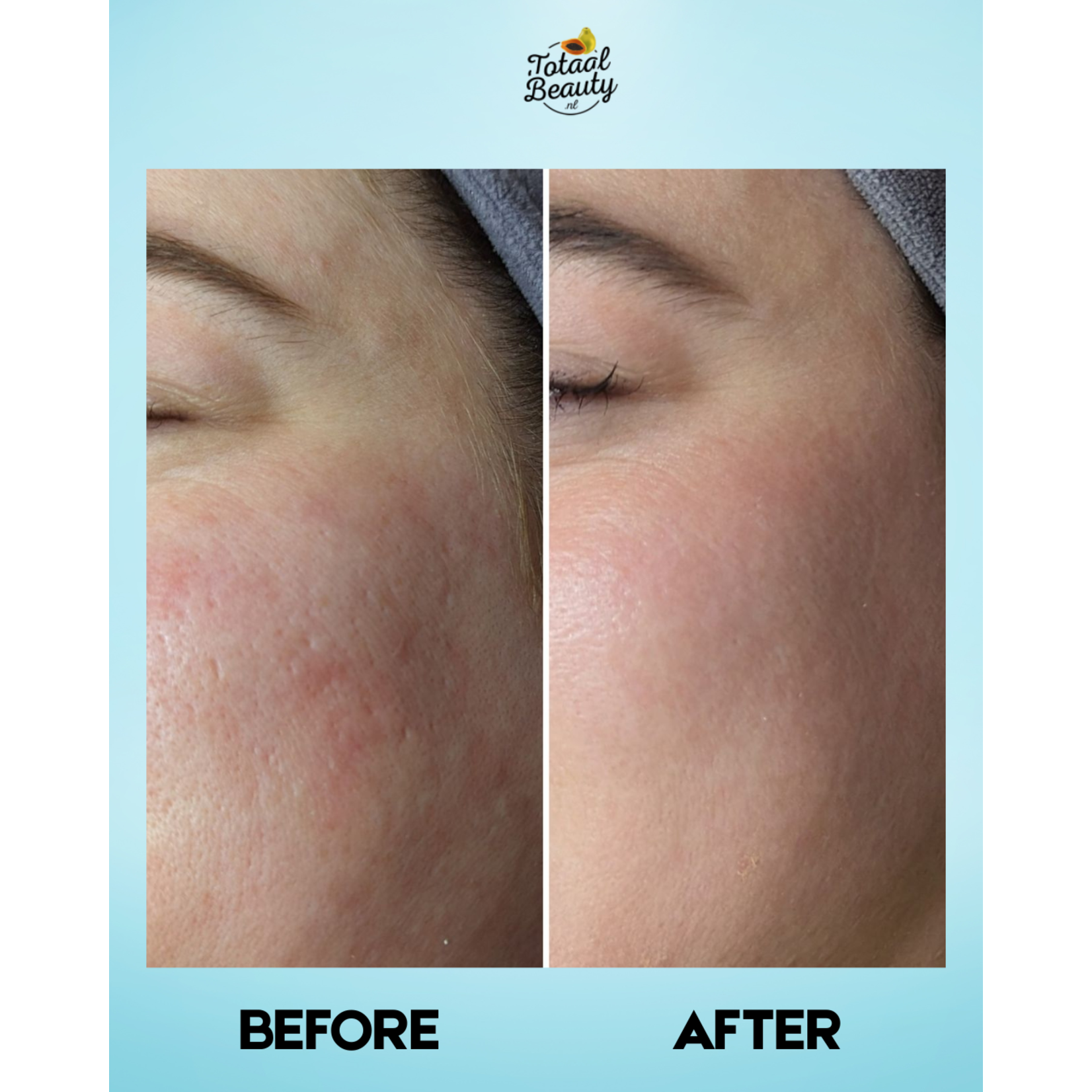 Kojie San, nummer één in anti-pigment producten! Kojie San Skin Lightening Pore Minimizing Toner – 100ml – Tegen Pigmentvlekken – Egale Huid – Porie Verfijnende Toner – Hydraterend & Verfrissend – Anti Acne – Kojic Acid Gezichtsverzorging