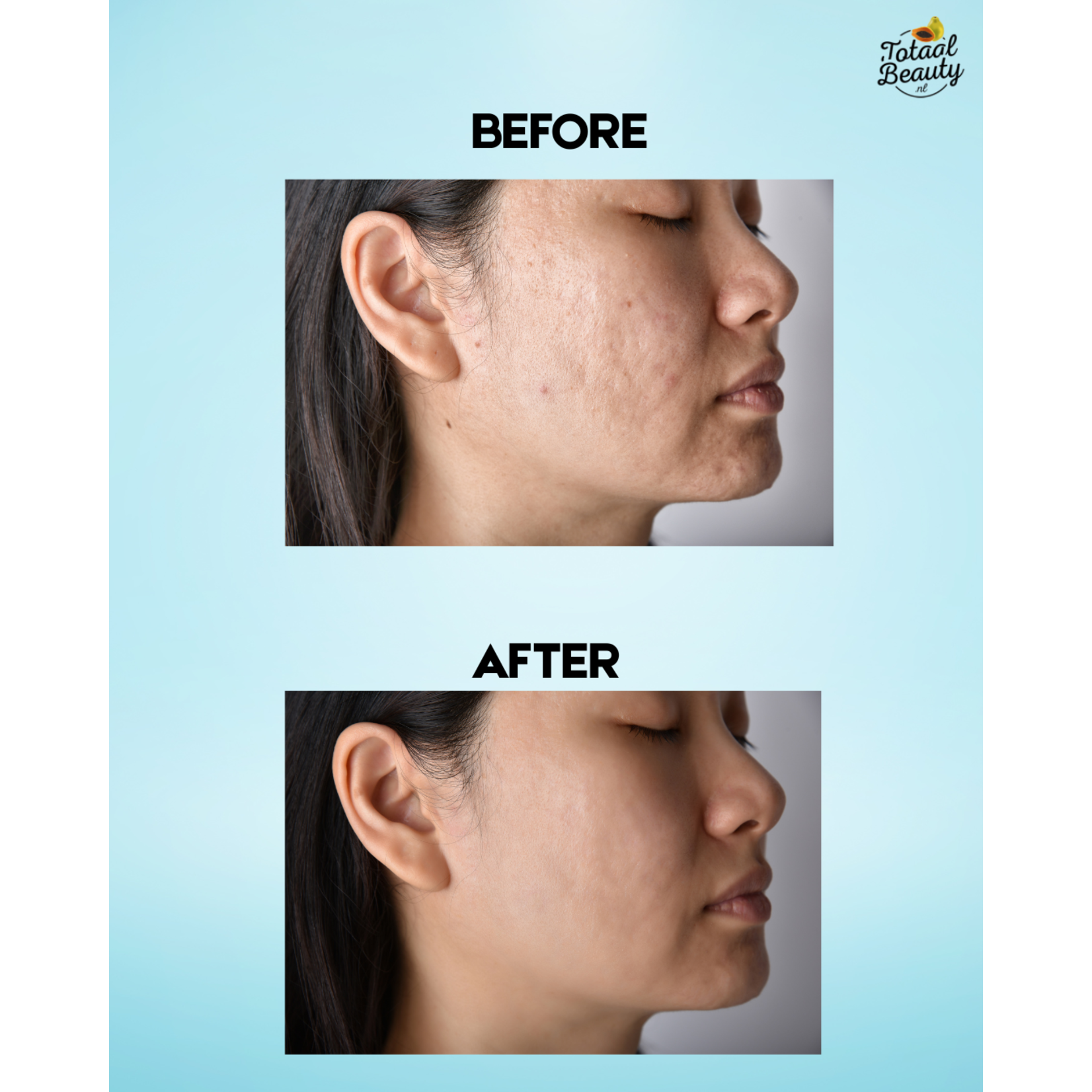 Alada,  één van de populaire whitening merken uit Thailand! Alada Skin Lightening Zeep – 160g – Tegen Pigmentvlekken – Donkere Vlekken Verwijderaar – Egale Huid – Whitening Gezichts- & Lichaamszeep – Natuurlijke Ingrediënten – Hydraterend & Verzorgend