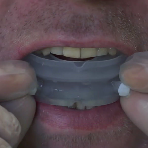 Snoring mouthpiece