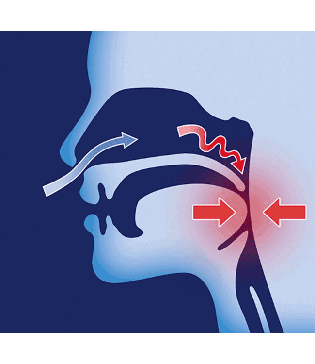 Custom-made Oniris anti-snoring brace (MRA).