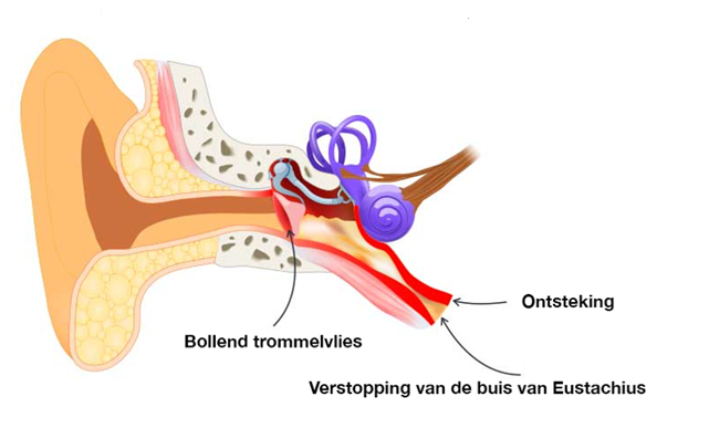 Middenoorontsteking kind