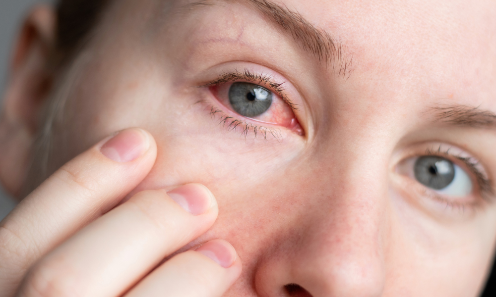 Rode ogen: hooikoorts, huisstofmijt of iets anders?