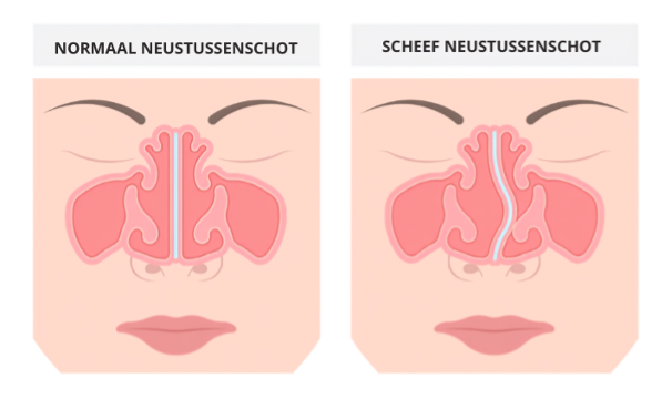 Illustratie van een normaal neustussenschot naast een scheef neustussenschot.