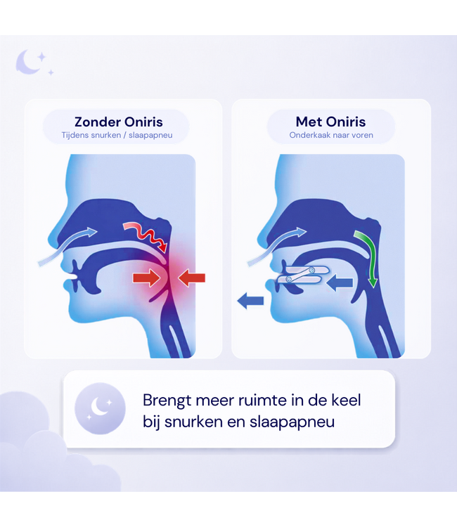 Oniris custom-made anti-snoring mouthpiece (MRA)