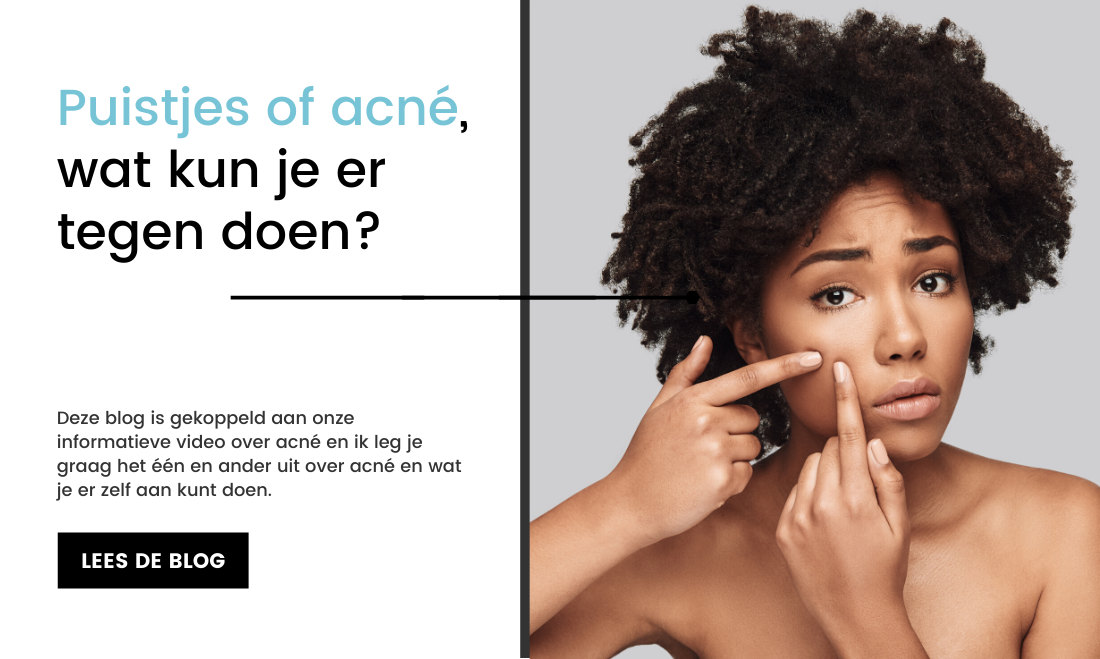 Schrikken Grace Schouderophalend Puistjes of acné, wat kun je er tegen doen? - Care for Skin