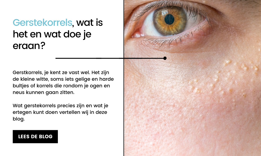 Gerstekorrels, wat is het en wat doe je eraan? Care for Skin Gerstekorrels, wat is het en wat doe je eraan? Care for Skin