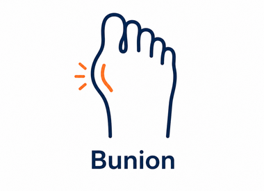 Bunion