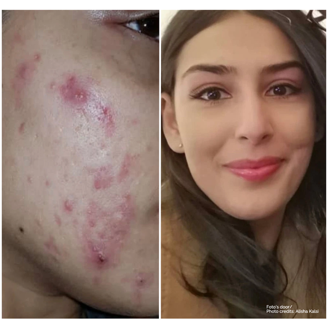 Clarol  Sebopure + Silver Serum + Exfoliating Wash Total Care Pack