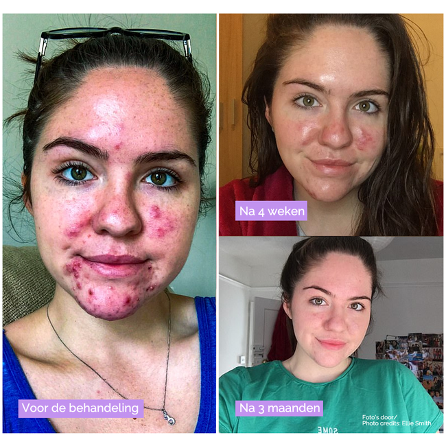 Clarol  Sebopure + Silver Serum + Exfoliating Wash Total Care Pack