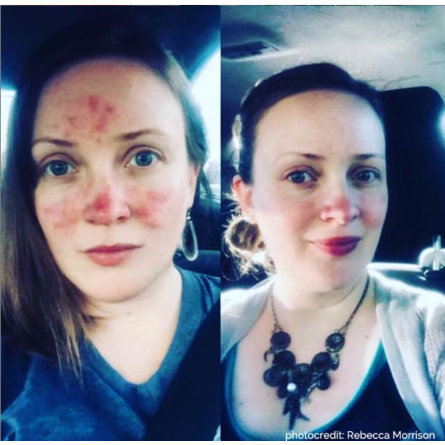 Kalme Skin Care Full Kit - huidverzorging Rosacea volledige lijn