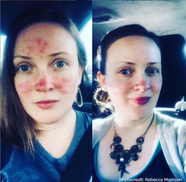 Kalme Skin Care Full kit Rosacea Nisim