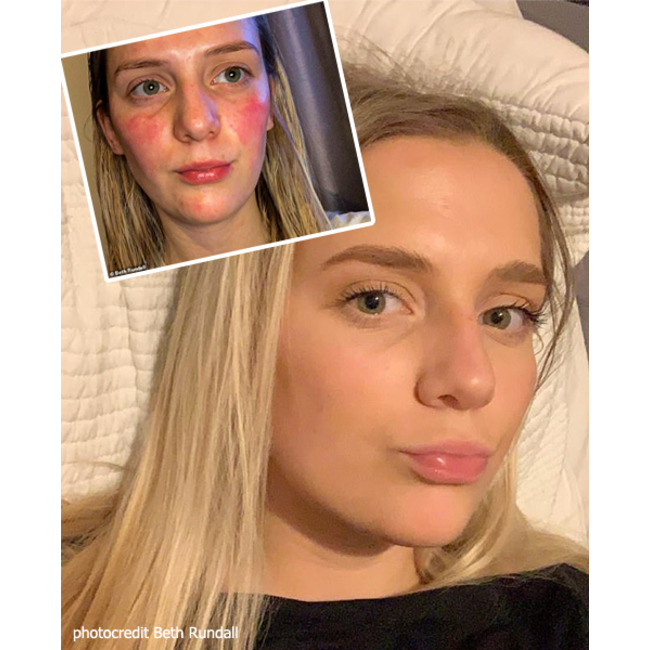 Kalme Skin Care Full Kit - huidverzorging Rosacea volledige lijn