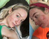 Hoe stress mijn cystische acne triggerde (en hoe ik er weer vanaf kwam!)