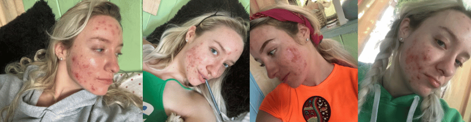 Hoe stress mijn cystische acne triggerde (en hoe ik er weer vanaf kwam!)