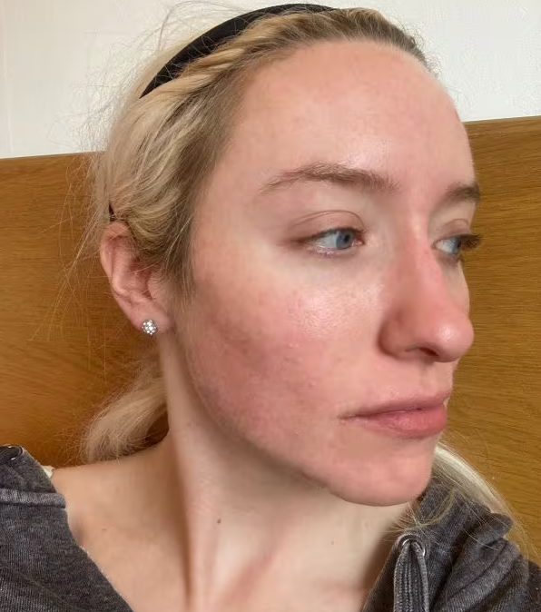 Na haar behandeling tegen cystische acne
