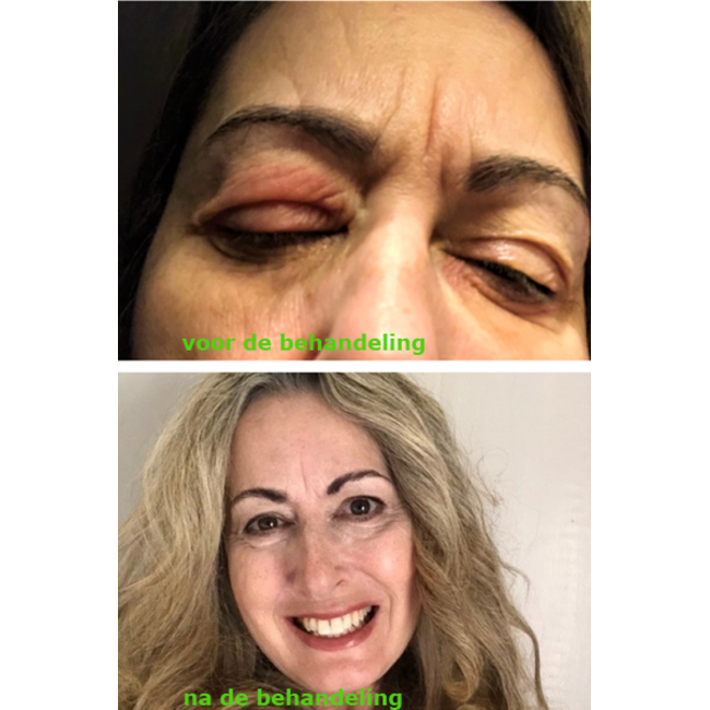 Hydrosil Hydrosil Ooglid Verzorgingsset (3-delig) – Tegen Blefaritis & Eczeem