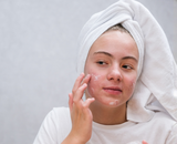 Acne en huidflora: herstel de balans van je huid