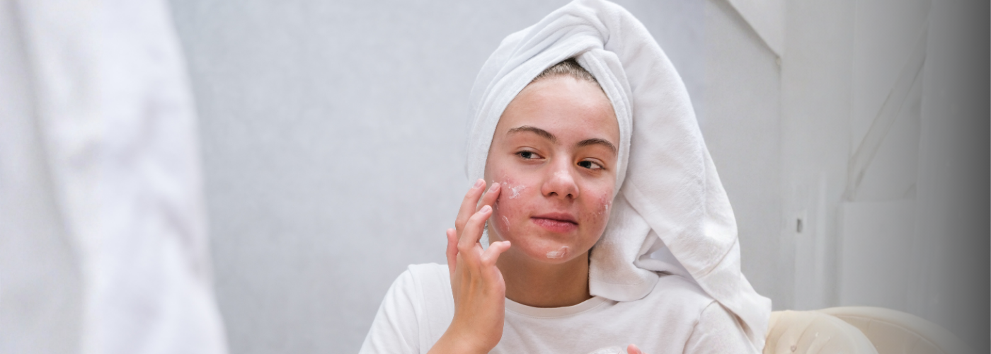 Acne en huidflora: herstel de balans van je huid