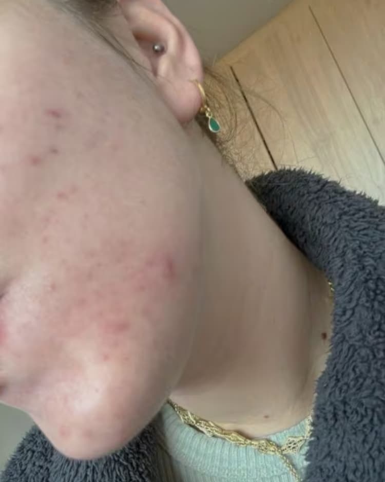 Dominika’s huid na enkele weken