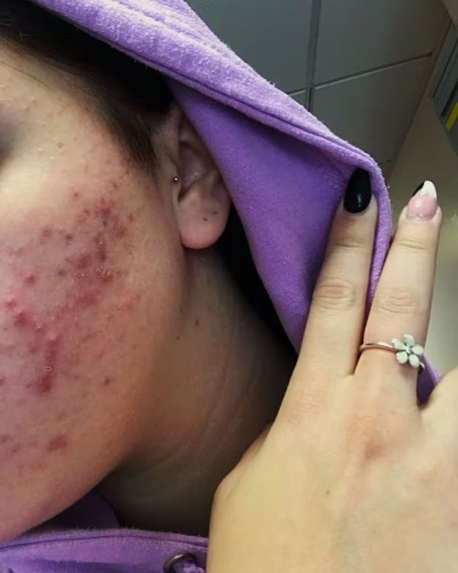 Ontstekingen en roodheid op de wangen