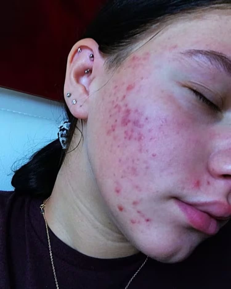 Dominika vóór haar nieuwe huidroutine