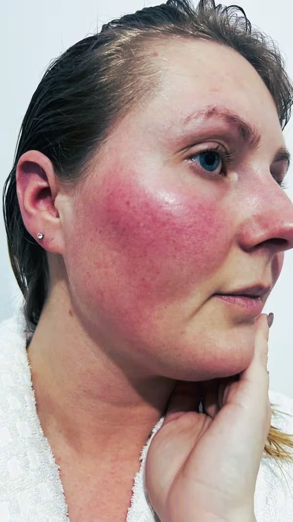 Biancia-Rosacea-voor