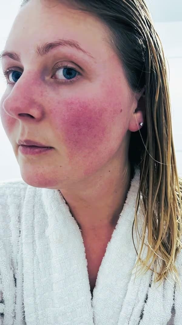Bianca-jonge-vrouw-rosacea-voor-1
