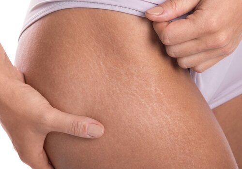 Cellulite Körper Cellulite Körper
