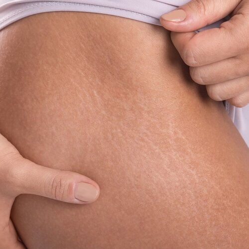 Cellulite Körper