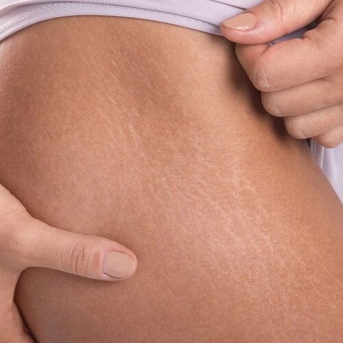Cellulite lichaam