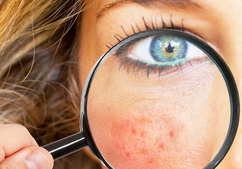 Rosacea oder couperose Rosacea oder couperose