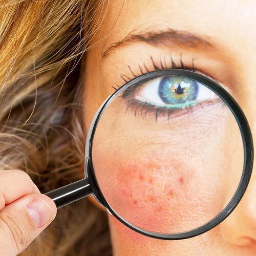 Skincare for Rosacea and Dilated Blood Vessels