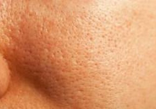 Grobe Poren Grobe Poren