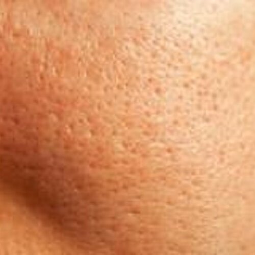Coarse pores