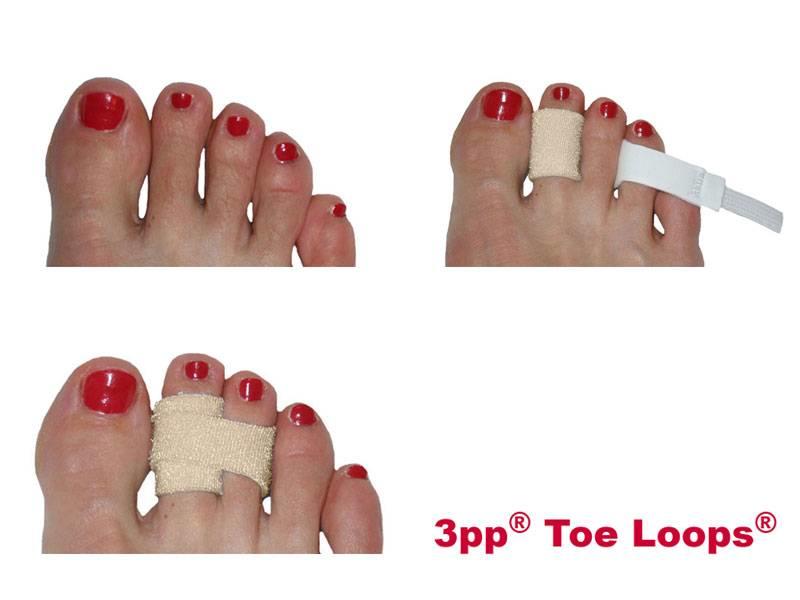3 Point Products 3pp® Toe Loops® for hammer toe