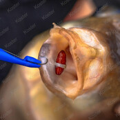 Bander / Disgorger Twin Pack