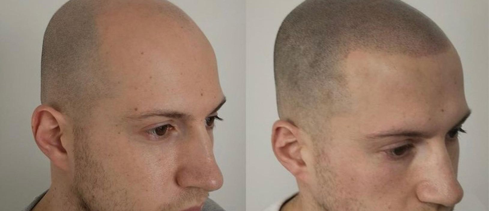 Before and after of an amazing procedure we did. We are the best in the art  of hair tattoo and scalp pigmentation. | Hair tattoos, Hairline tattoos, Scalp  tattoo